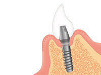 インプラント